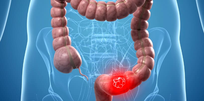 combatir eficazmente una enfermedad tan devastadora como el cáncer de colon
